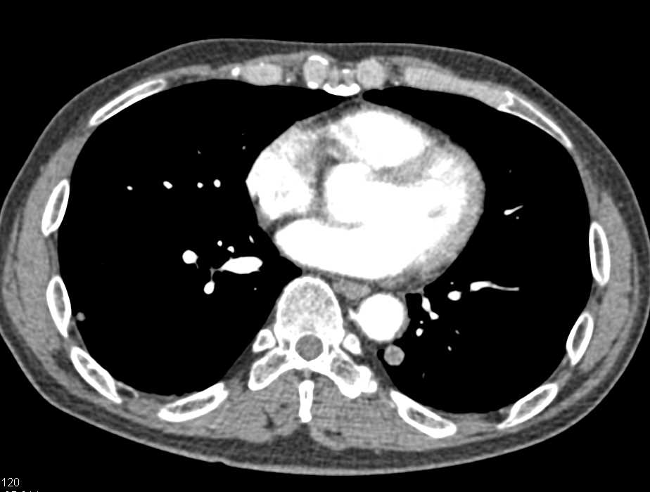 Implants Nicely Seen Around the Spleen - CTisus CT Scan