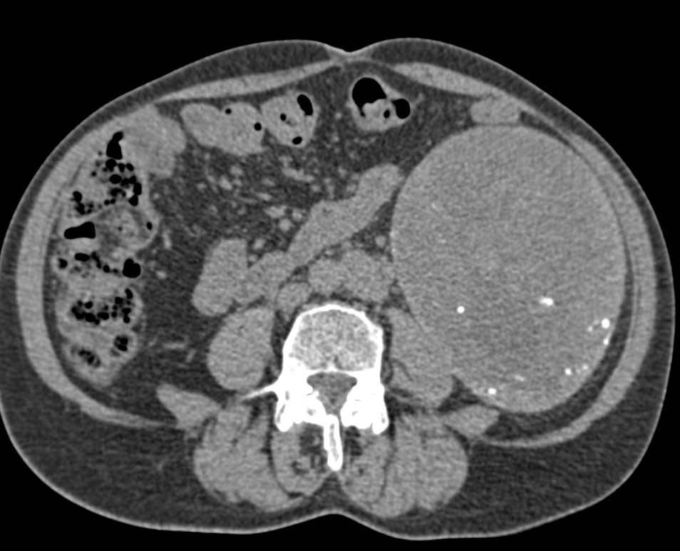 Splenic Hamartoma - CTisus CT Scan