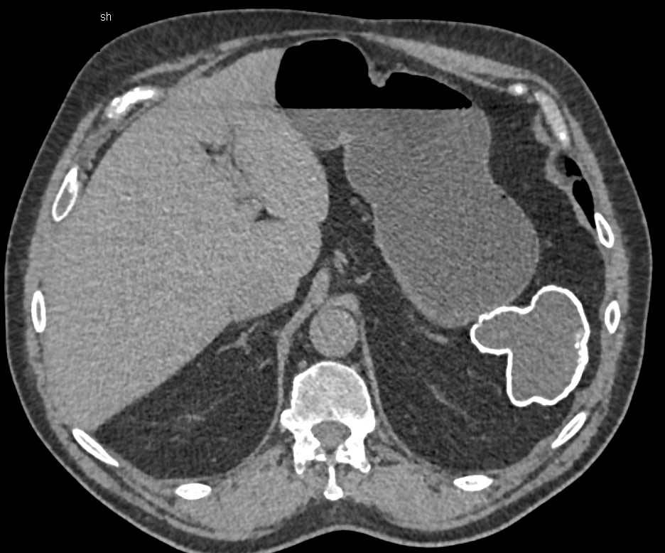 Auto infarcted and Calcified Spleen - CTisus CT Scan