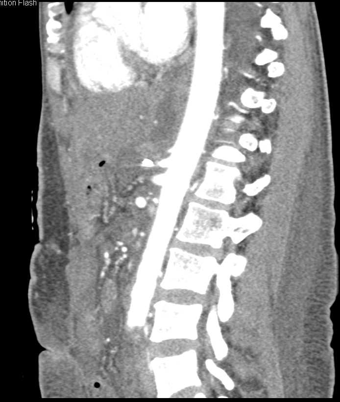 Splenic Infarct and Pneumatosis Left Colon - CTisus CT Scan