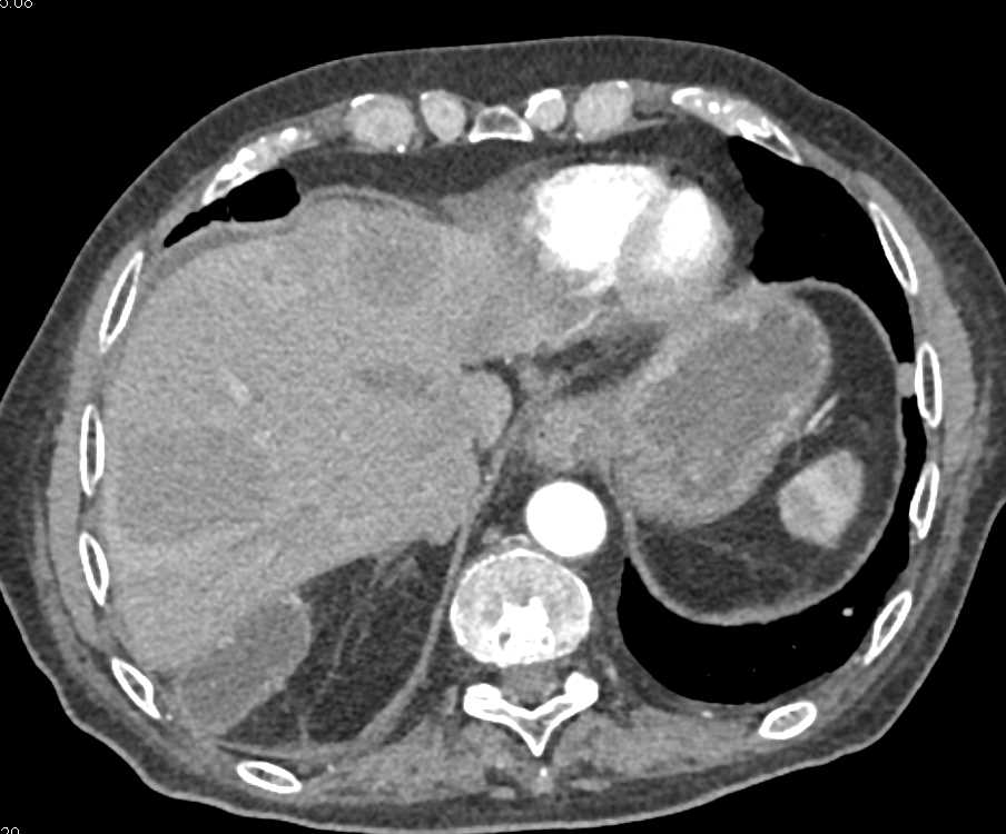 Lymphoma with Extensive Tumor and Vascular Involvement - CTisus CT Scan