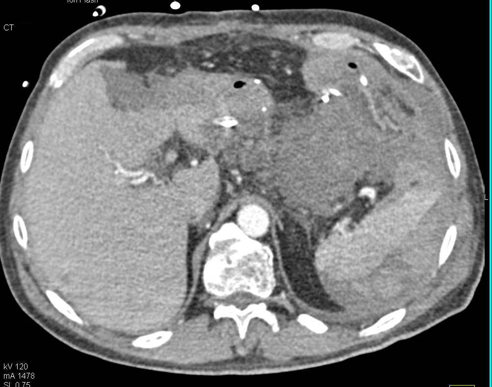 Perisplenic Bleed - CTisus CT Scan