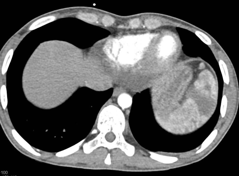 Multiple Renal and Splenic Infarcts - CTisus CT Scan