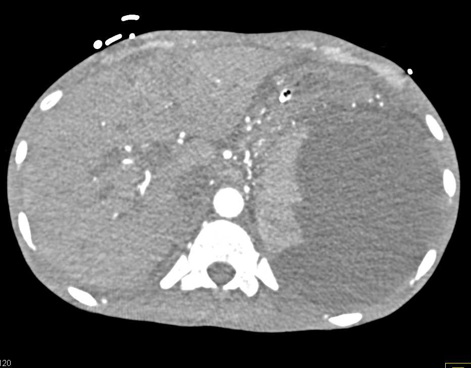 Subcapsular Hematoma in the Spleen - CTisus CT Scan