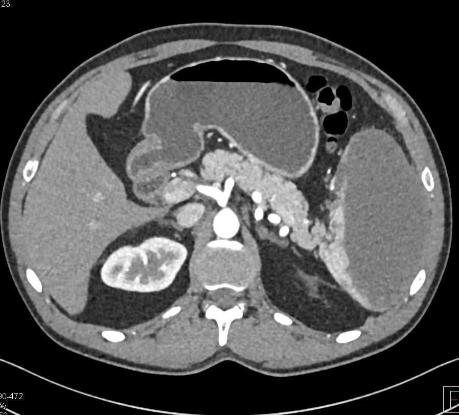 Large Splenic Infarction - CTisus CT Scan