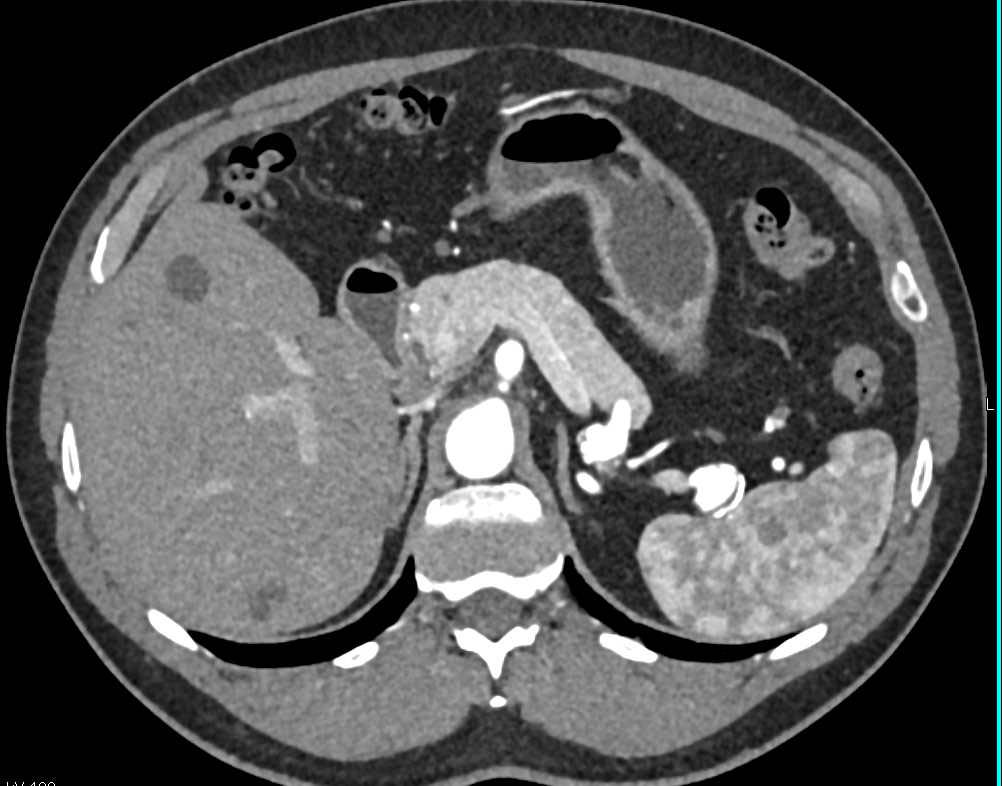 Splenic Artery Aneurysm - CTisus CT Scan