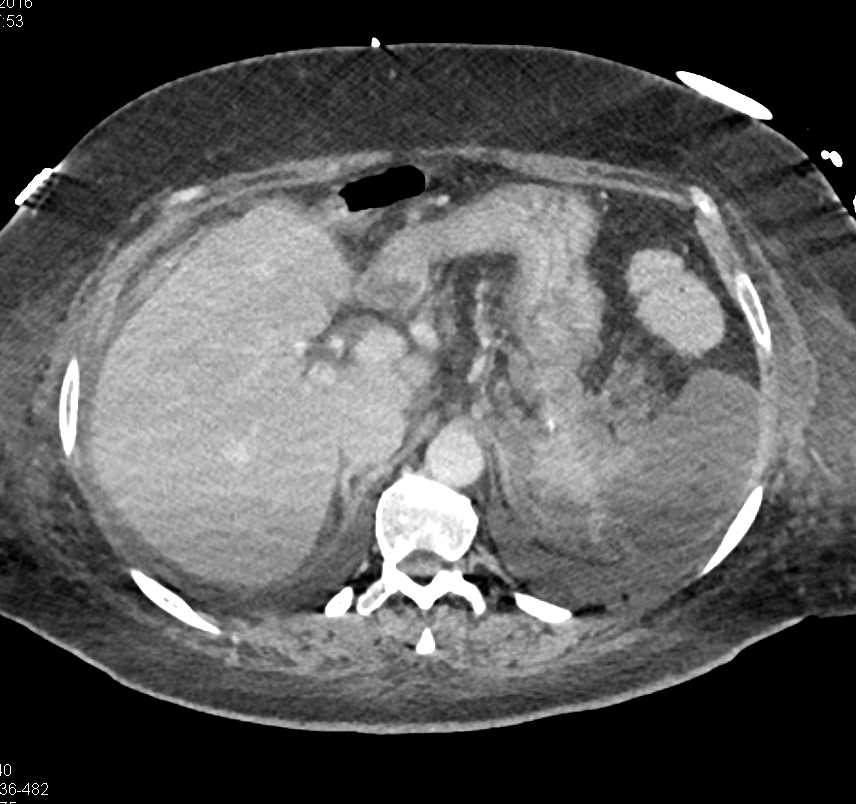 Pancreatitis with an Infarcted Spleen - CTisus CT Scan