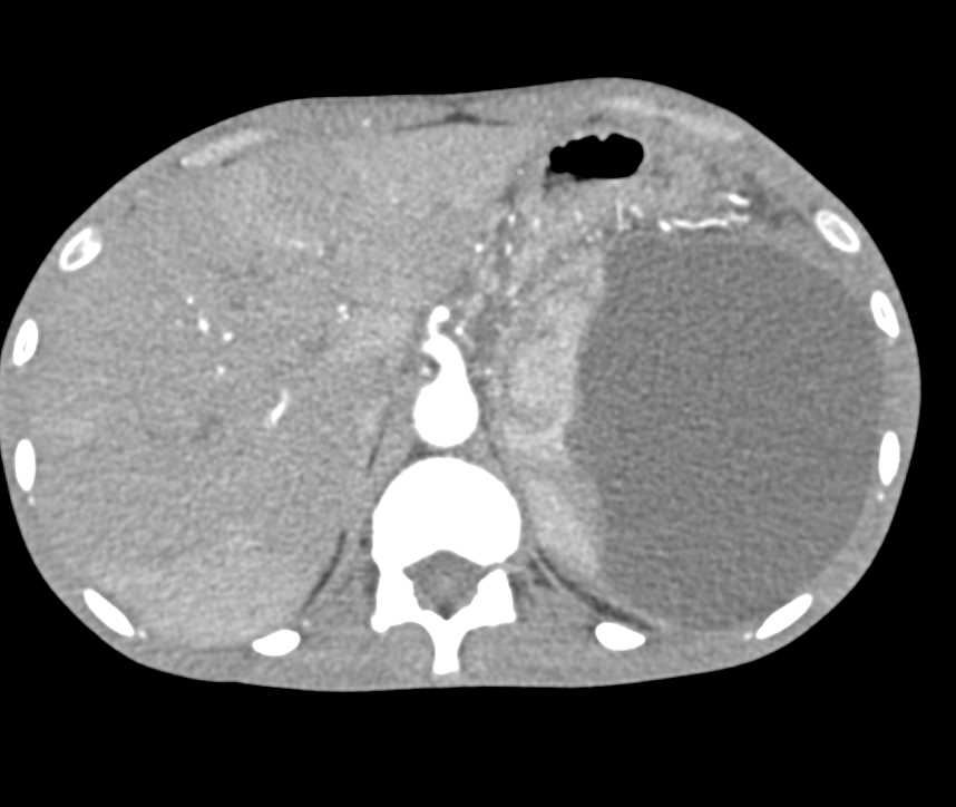 Subcapsular Hematoma Spleen - CTisus CT Scan