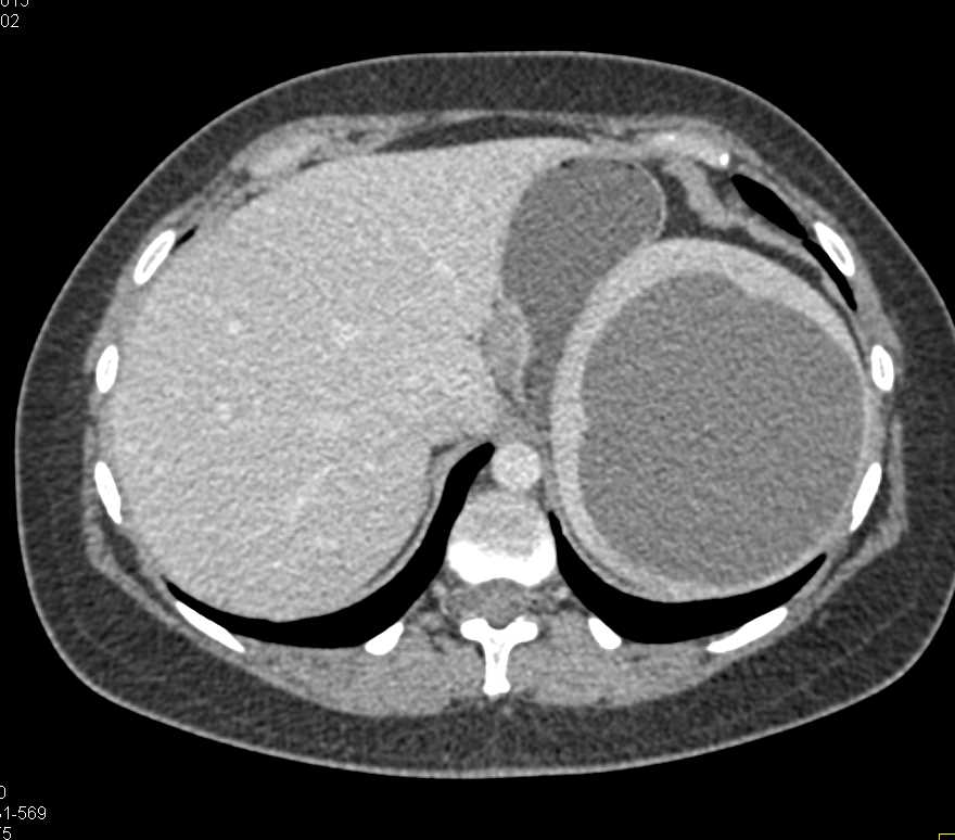 Splenic Cyst - CTisus CT Scan