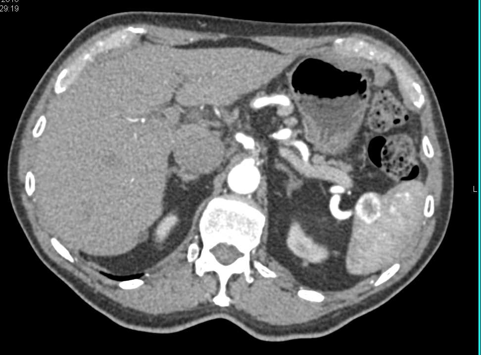 Multiple Splenic Hemangiomas - CTisus CT Scan
