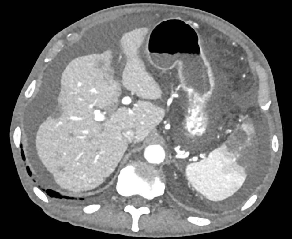 Ascites, Splenic Infarcts and Hepatic Infarcts - CTisus CT Scan