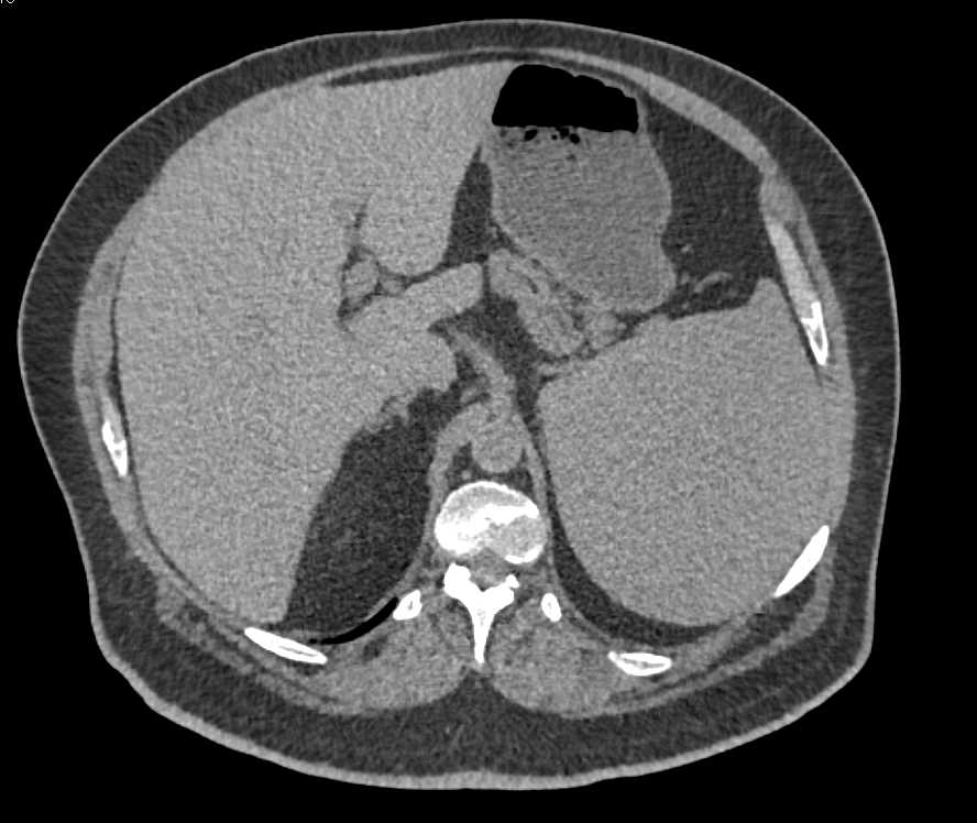 Splenic Hamartoma - CTisus CT Scan
