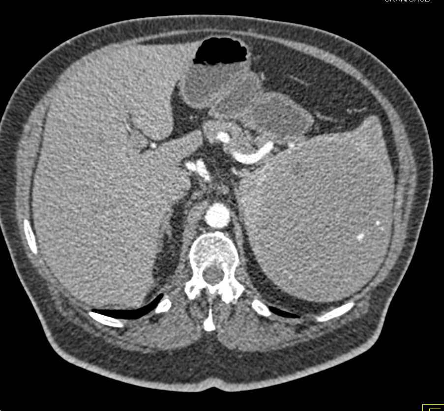 Splenic Hamartoma - CTisus CT Scan
