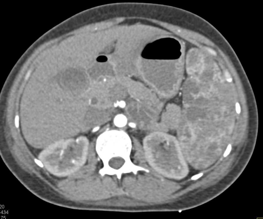 Multiple Splenic Hemangiomas - CTisus CT Scan