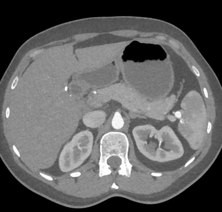 Splenic Artery Aneurysm - CTisus CT Scan
