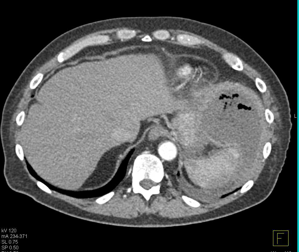 Abscess in the Left Upper Quadrant - CTisus CT Scan