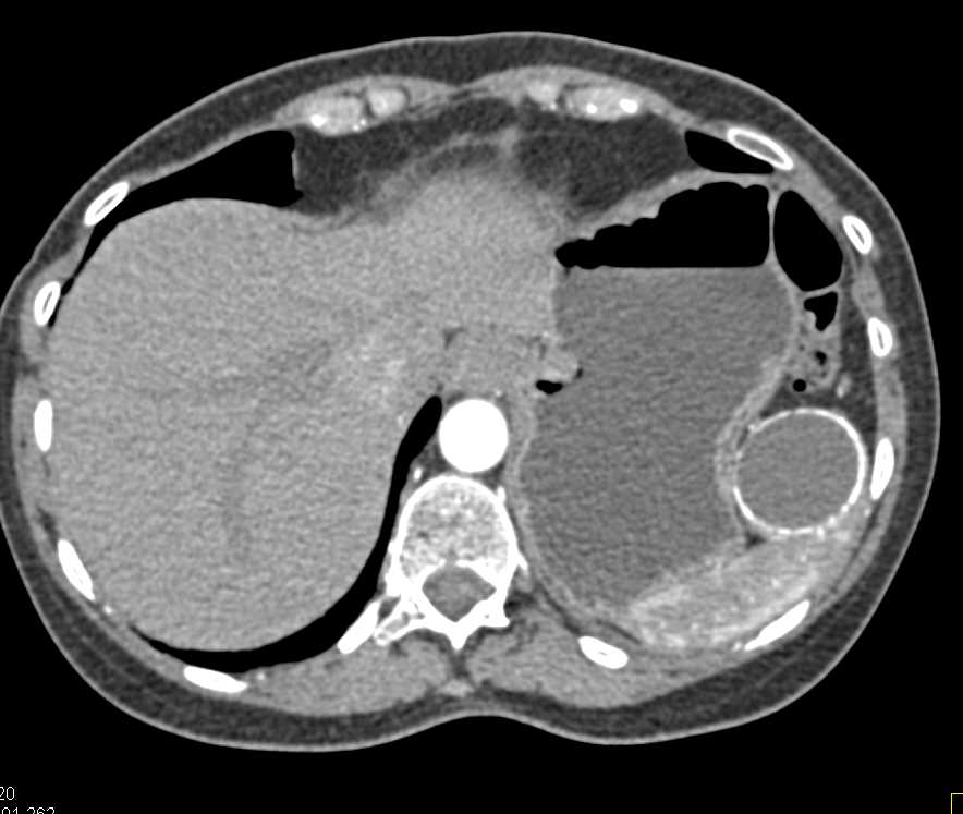 Calcified Splenic Cyst due to Prior Hematoma - CTisus CT Scan