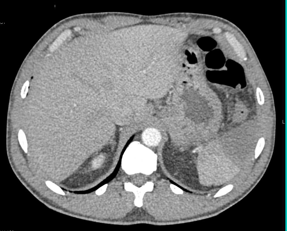 Splenic Infarct - CTisus CT Scan