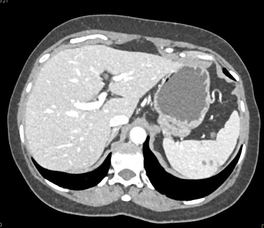 Splenic Hemangiomas - CTisus CT Scan