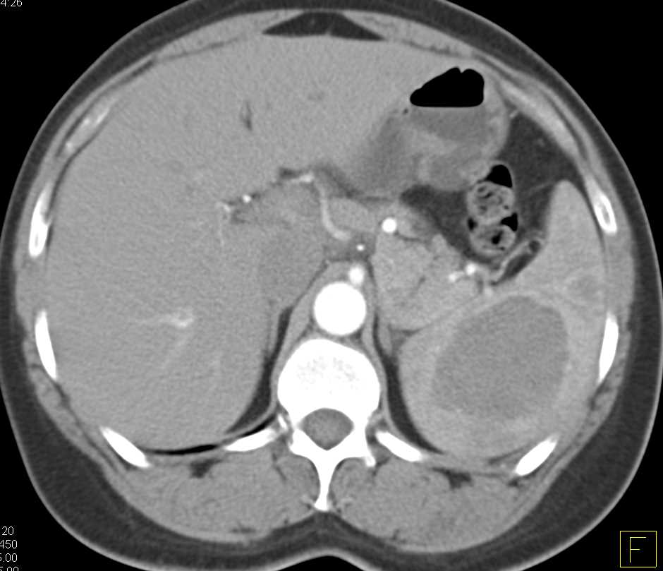 Littoral Cell Angioma - CTisus CT Scan