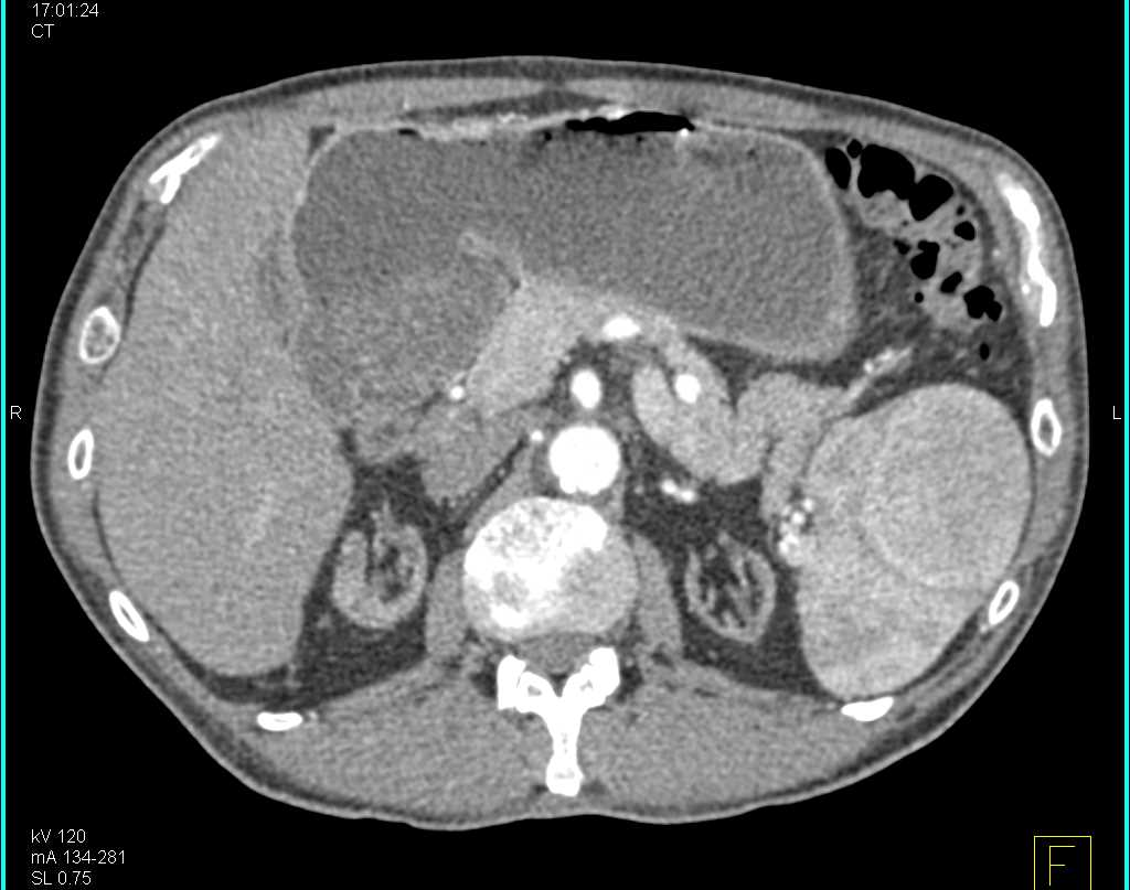 Incidental Splenic Hamartoma in Patient with End Stage Renal Disease (ESRD) and Renal Transplant - CTisus CT Scan