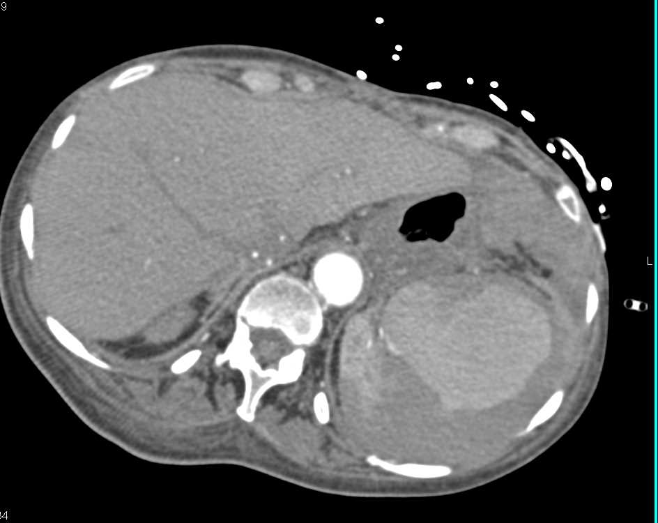 Active Bleed from a Splenic Artery Aneurysm and Subsequent Embolization - CTisus CT Scan