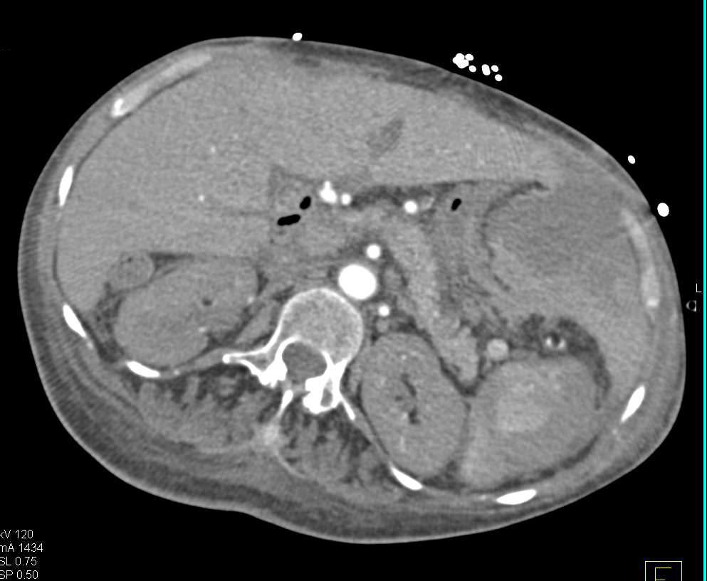 Active Bleed from a Splenic Artery Aneurysm and Subsequent Embolization - CTisus CT Scan