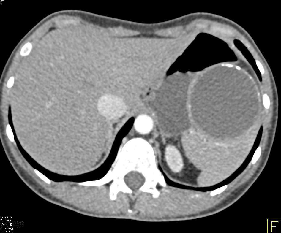 Calcified Splenic Cyst - CTisus CT Scan