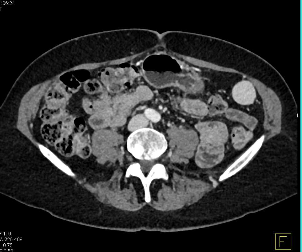 Accessory Spleen Left Lower Quadrant - CTisus CT Scan