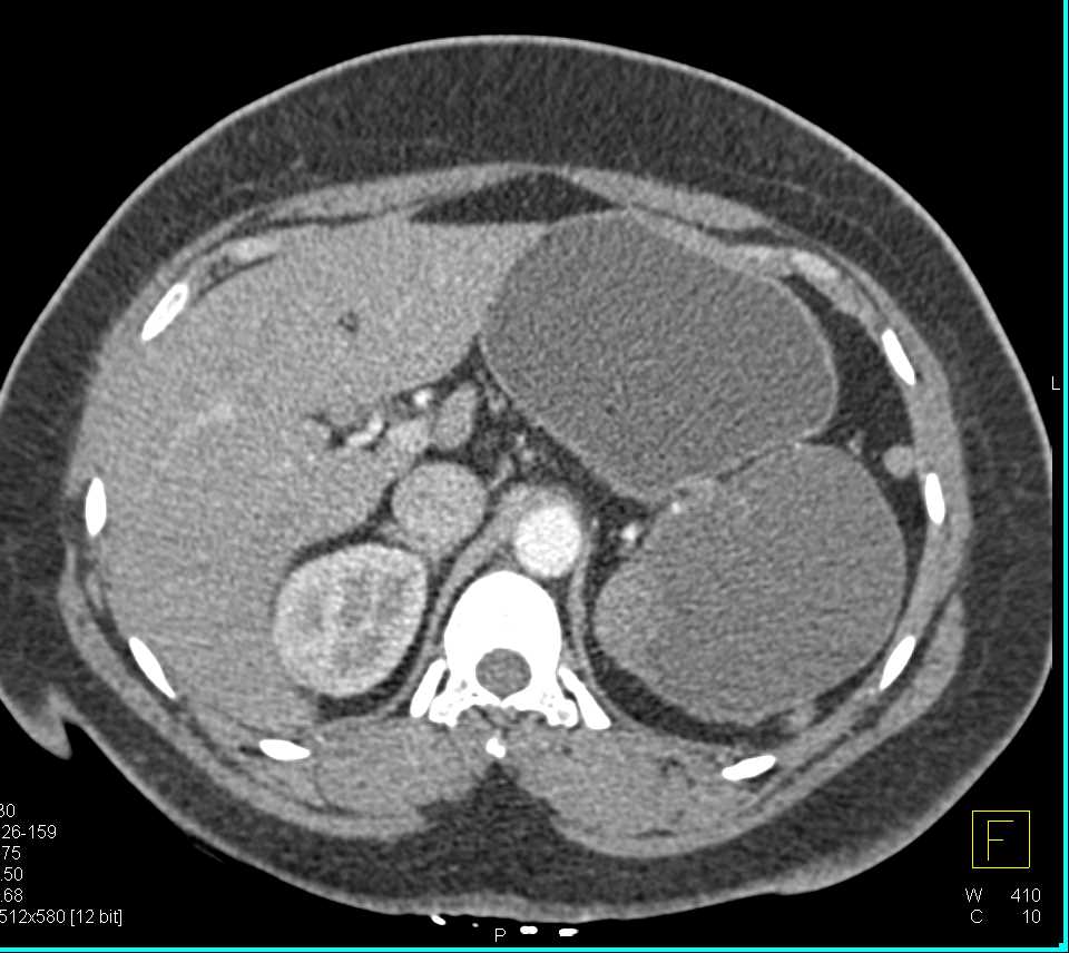 Splenic Cyst - CTisus CT Scan