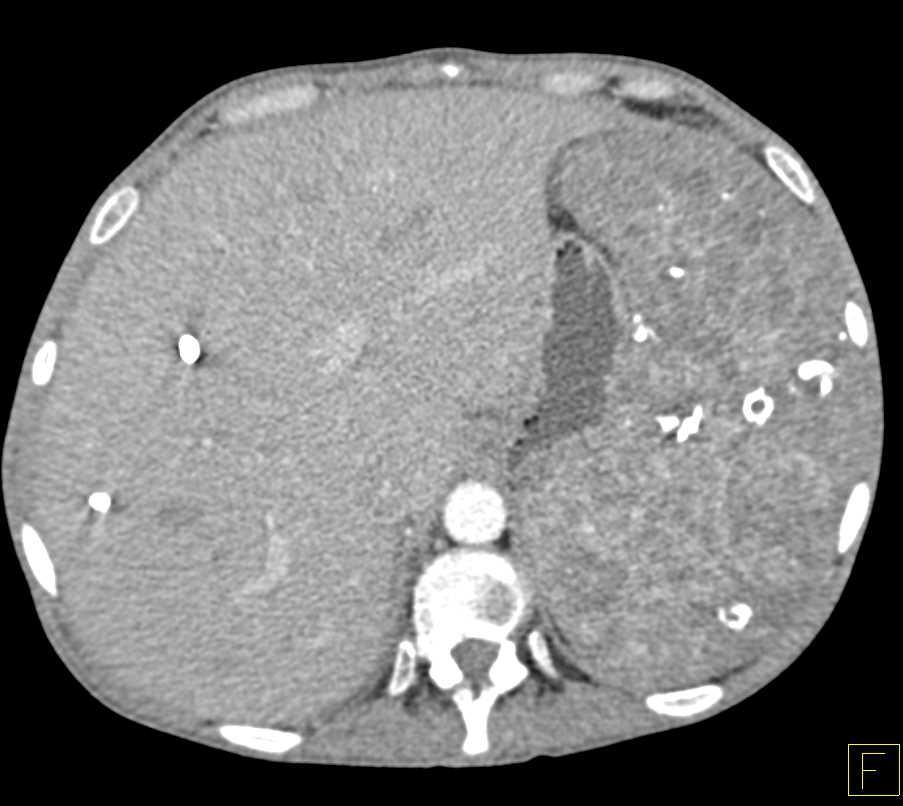 Klippel-Trenaunay-Weber (KTW) Syndrome with Splenic and Bladder Hemangiomas - CTisus CT Scan
