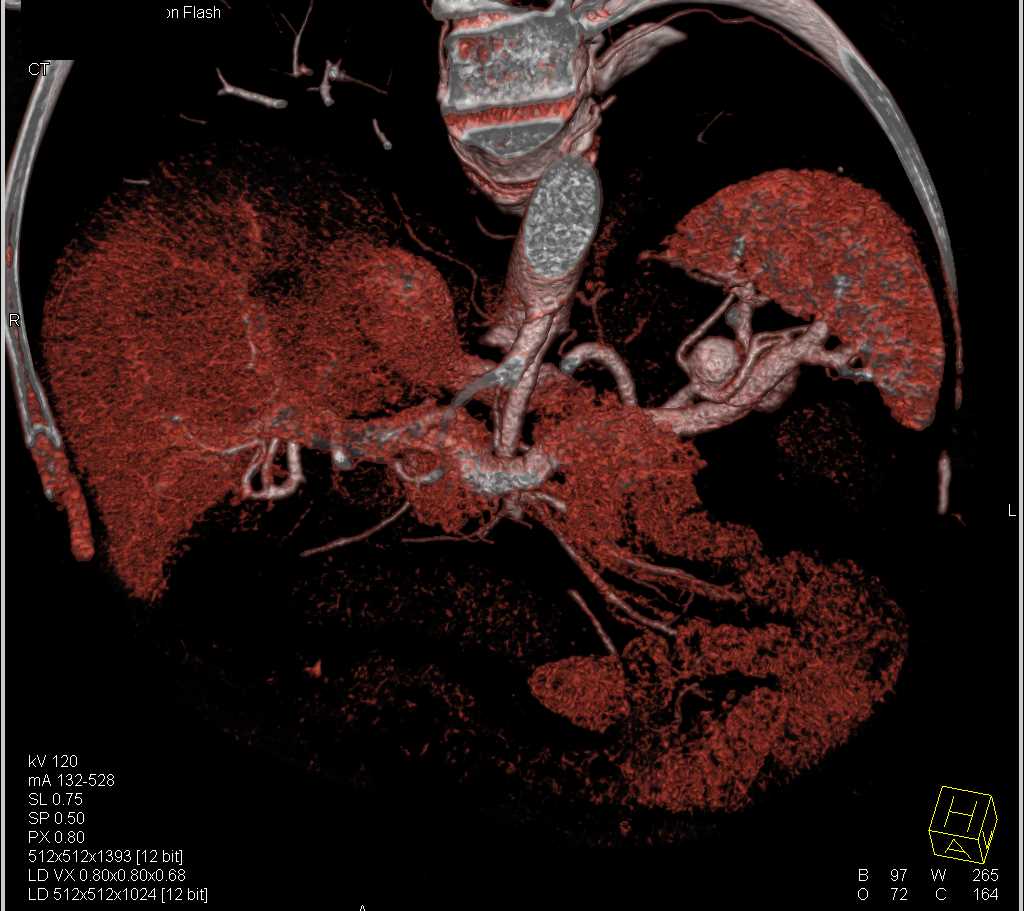 Splenic Artery Aneurysm - CTisus CT Scan