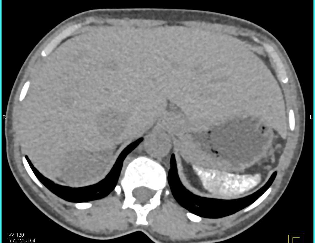 Sickle Cell Disease with Spleen, Bone and Kidney Involvement (Papillary Necrosis) - CTisus CT Scan