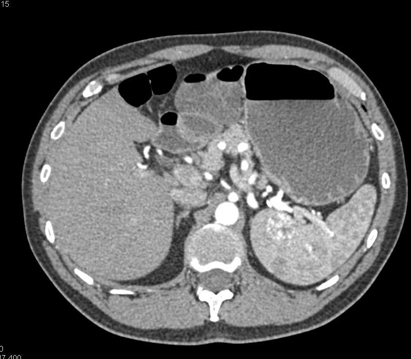 Splenic Hemangiomas - CTisus CT Scan