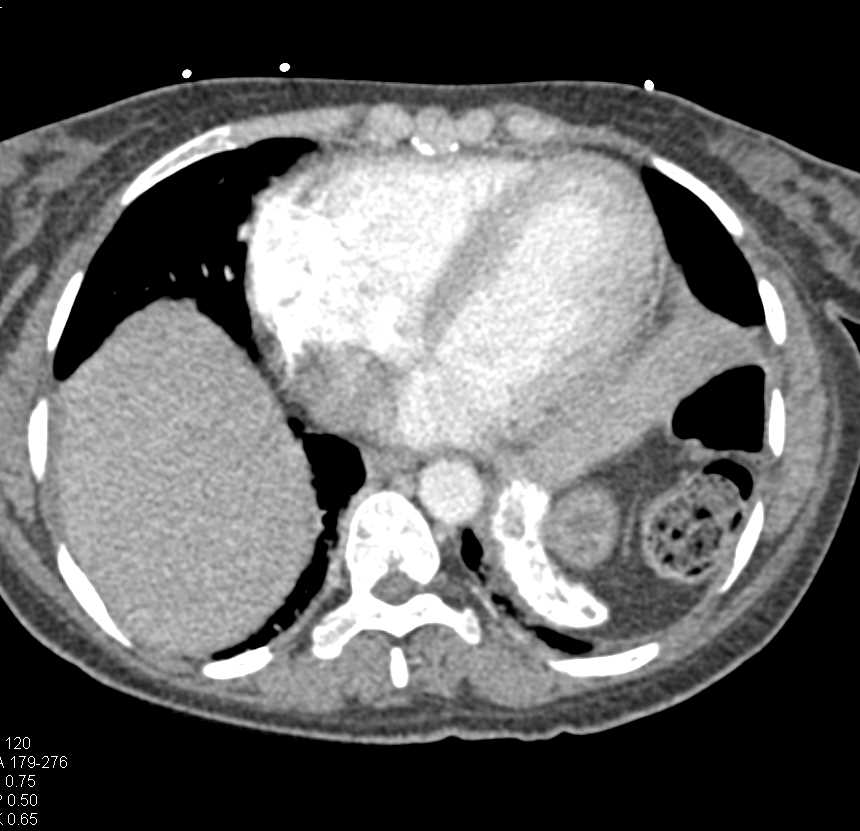 Calcified Spleen in Sickle Cell Disease - CTisus CT Scan