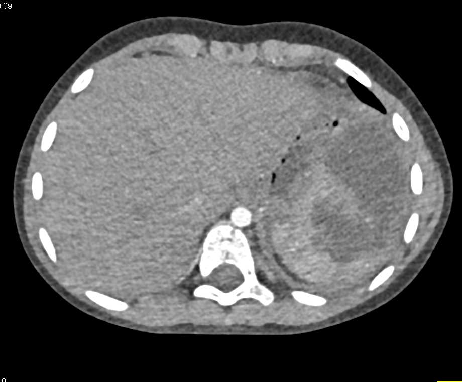 Splenic Cyst Became Infected with Abscess - CTisus CT Scan