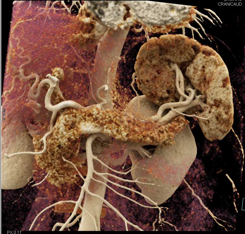 Normal Pancreas and Spleen with Cinematic Rendering - CTisus CT Scan