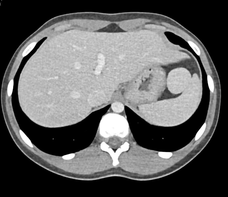5cm Accessory Spleen - CTisus CT Scan