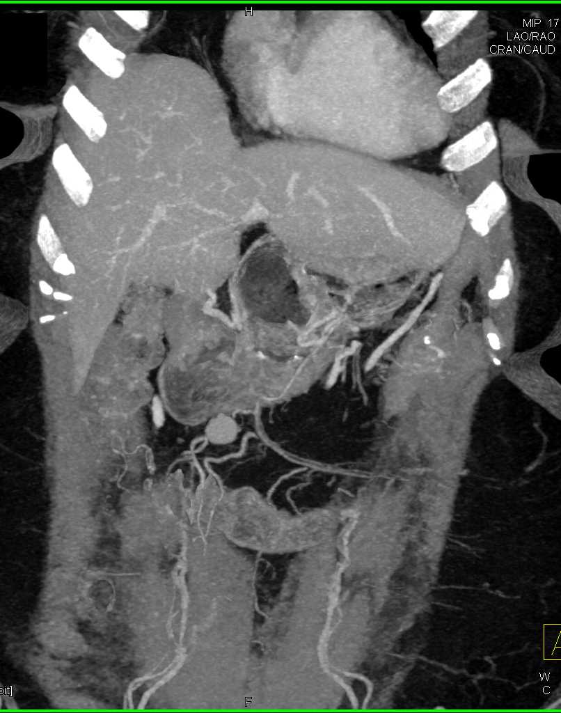 Splenule Simulates a Mesenteric Mass or Node - CTisus CT Scan