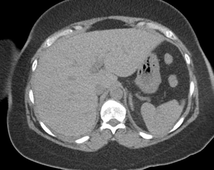 Active Splenic Bleed - CTisus CT Scan