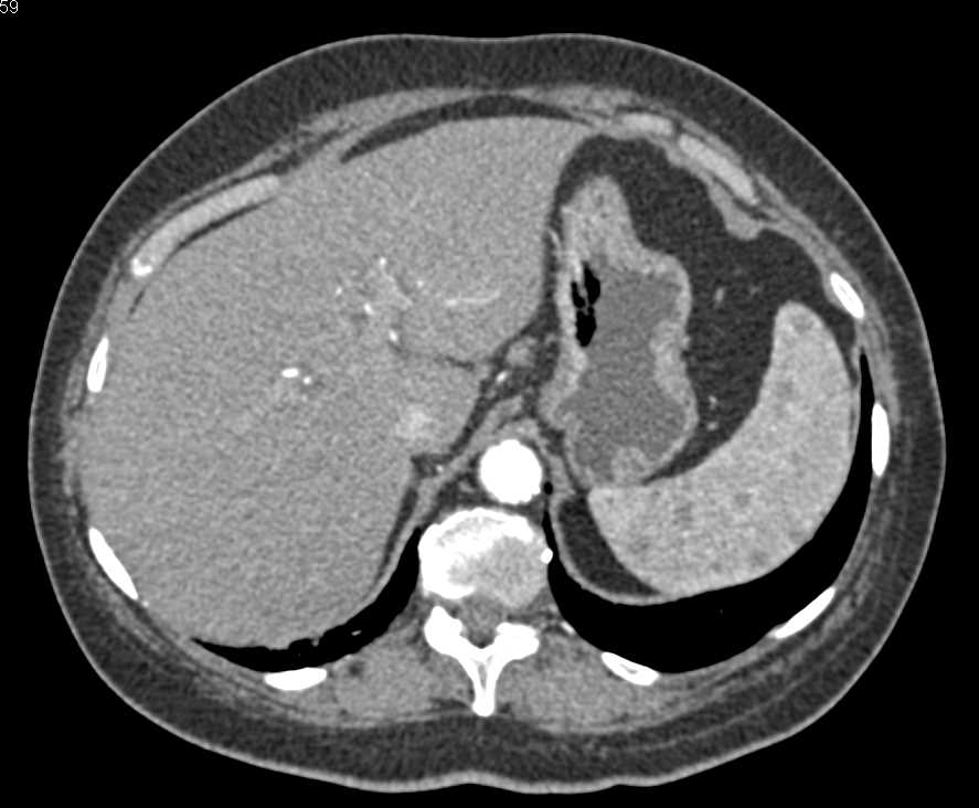 Metastatic Melanoma to Liver and Spleen and Bone - CTisus CT Scan