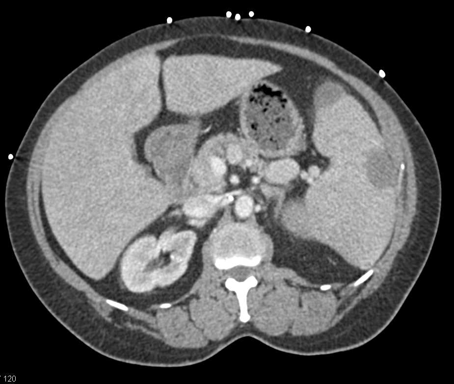 Primary Splenic Lymphoma - CTisus CT Scan