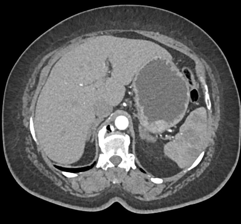 Primary Splenic Lymphoma - CTisus CT Scan
