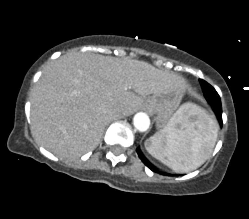 Multiple Splenic and Renal Abscess due to Candidiasis - CTisus CT Scan