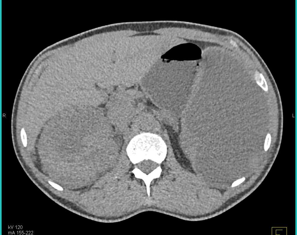 Renal Cell Carcinoma with Vascular Invasion and Infarcted Spleen - CTisus CT Scan