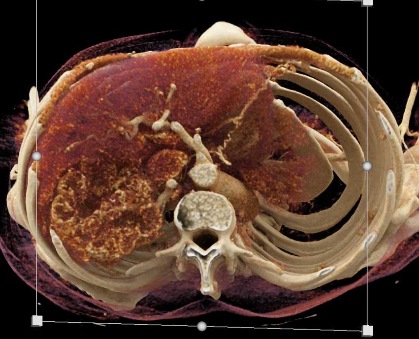 Renal Cell Carcinoma with Vascular Invasion and Infarcted Spleen - CTisus CT Scan