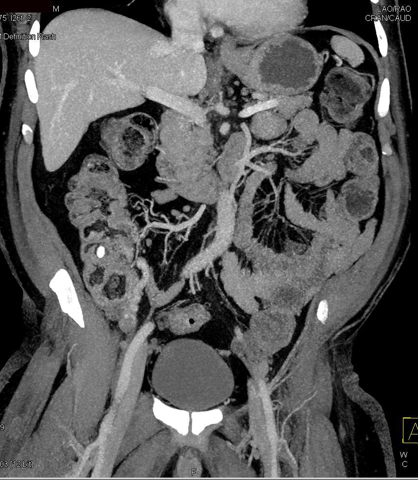 Accessory Spleen Simulates an Adrenal Mass - CTisus CT Scan