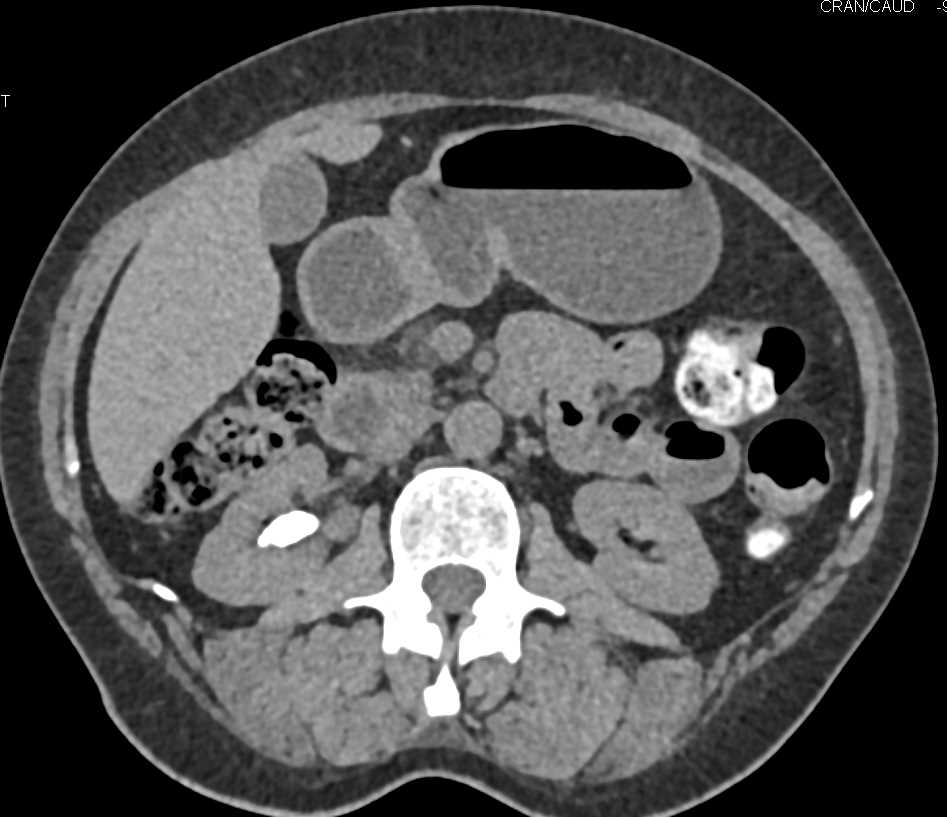 Accessory Spleen Tail of Pancreas - CTisus CT Scan