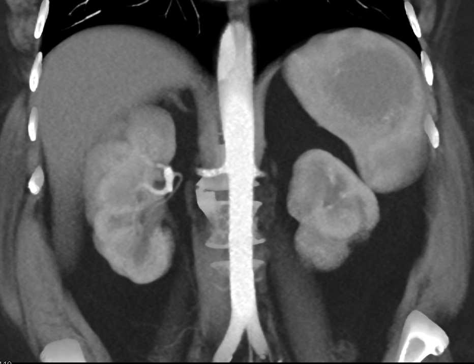 Splenic Hamartoma - CTisus CT Scan
