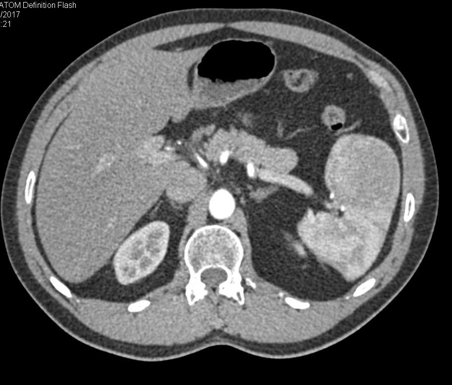 Splenic Hamartoma - CTisus CT Scan